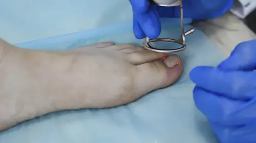 usuwanie wrastających paznokci